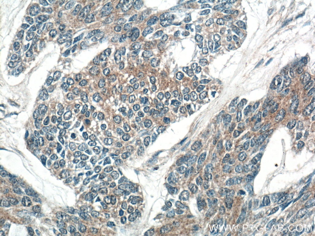 IHC staining of human skin cancer using 21051-1-AP