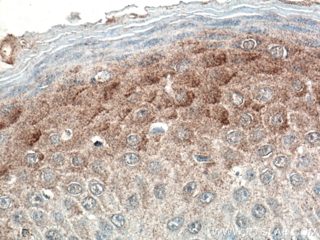 Immunohistochemistry (IHC) staining of human skin cancer tissue using DKK2 Polyclonal antibody (21051-1-AP)