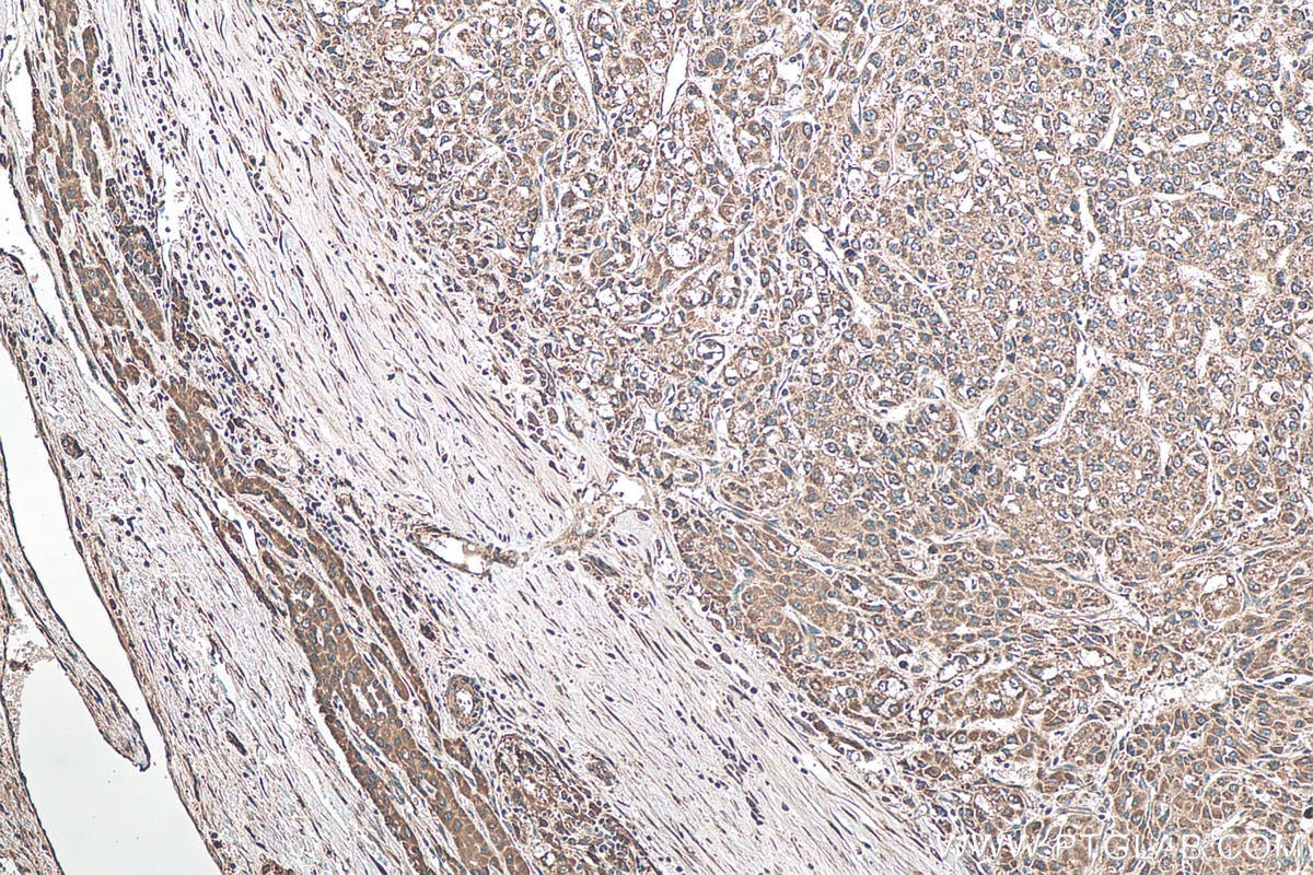 Immunohistochemistry (IHC) staining of human liver cancer tissue using DKK3 Polyclonal antibody (10365-1-AP)