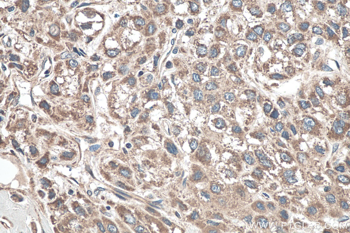 Immunohistochemistry (IHC) staining of human liver cancer tissue using DKK3 Polyclonal antibody (10365-1-AP)