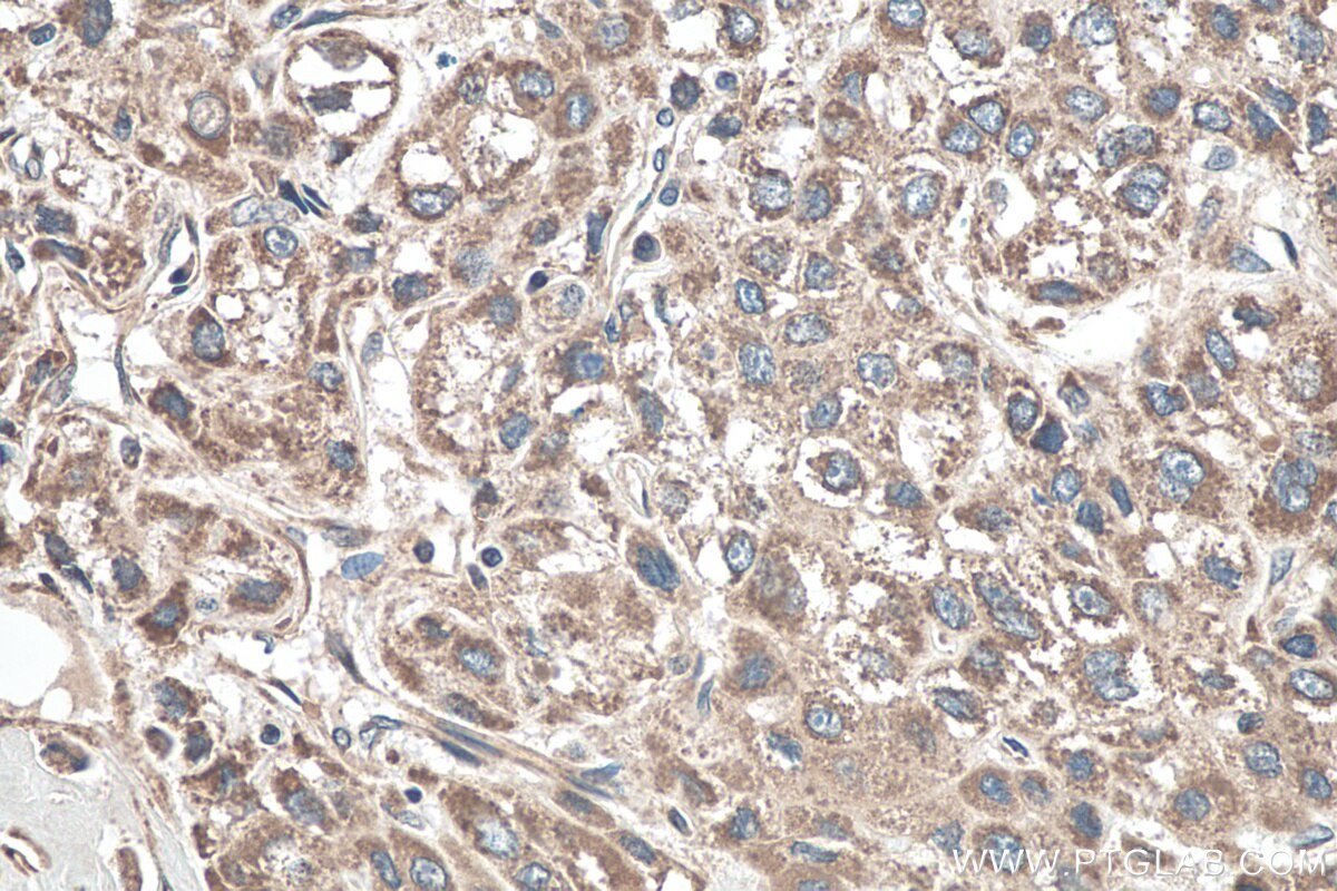 Immunohistochemistry (IHC) staining of human liver cancer tissue using DKK3 Polyclonal antibody (10365-1-AP)