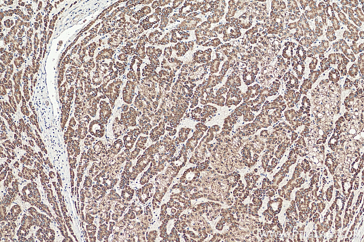 Immunohistochemistry (IHC) staining of human liver cancer tissue using DLAT Polyclonal antibody (13426-1-AP)