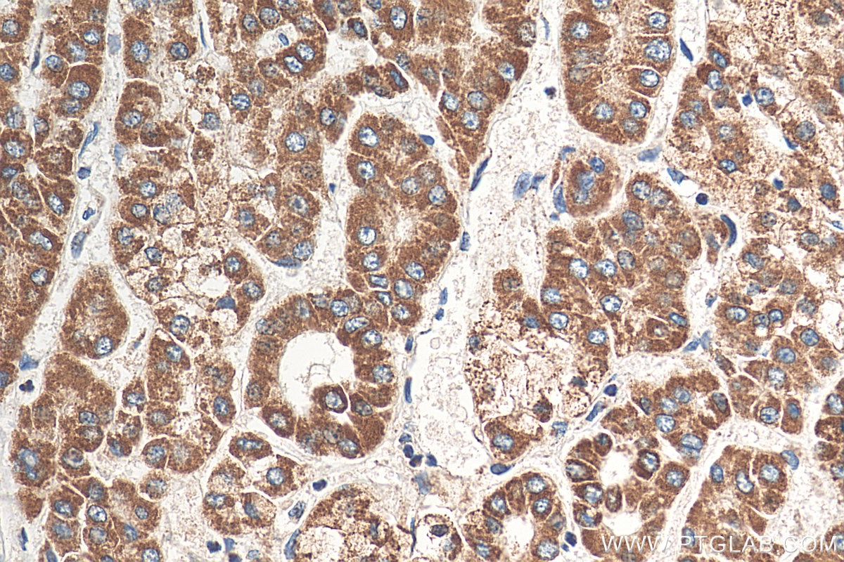 Immunohistochemistry (IHC) staining of human liver cancer tissue using DLAT Polyclonal antibody (13426-1-AP)