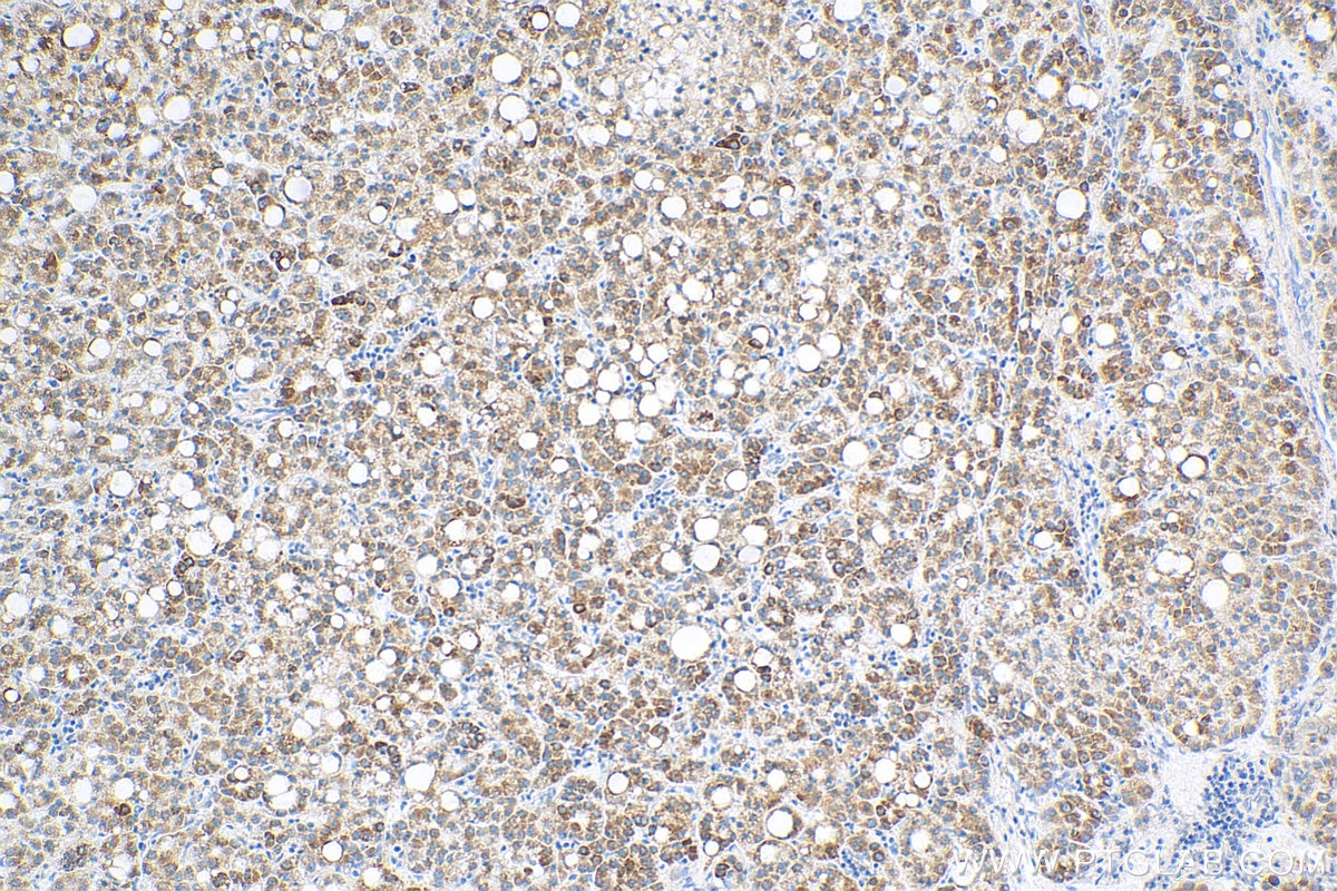 Immunohistochemistry (IHC) staining of human liver cancer tissue using DLAT Monoclonal antibody (68303-1-Ig)