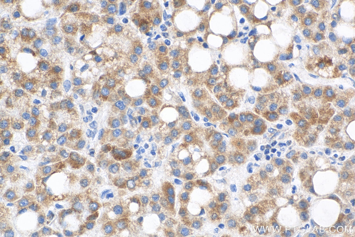 Immunohistochemistry (IHC) staining of human liver cancer tissue using DLAT Monoclonal antibody (68303-1-Ig)