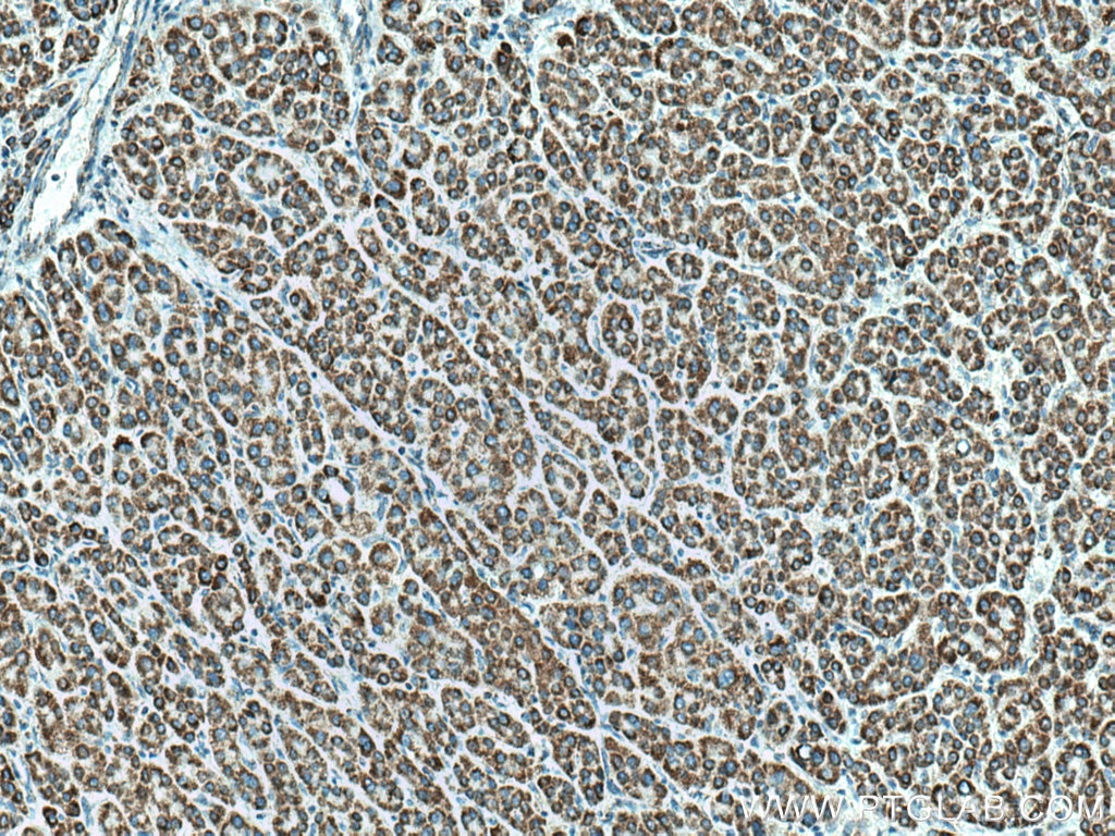 Immunohistochemistry (IHC) staining of human liver cancer tissue using DLD Polyclonal antibody (16431-1-AP)