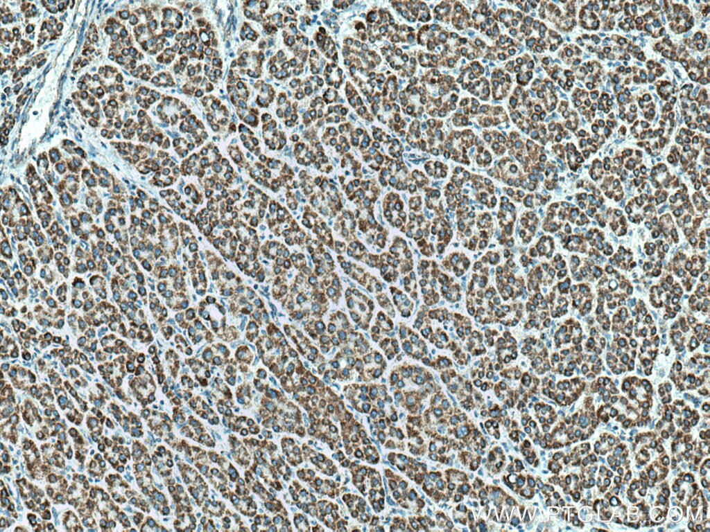 IHC staining of human liver cancer using 16431-1-AP