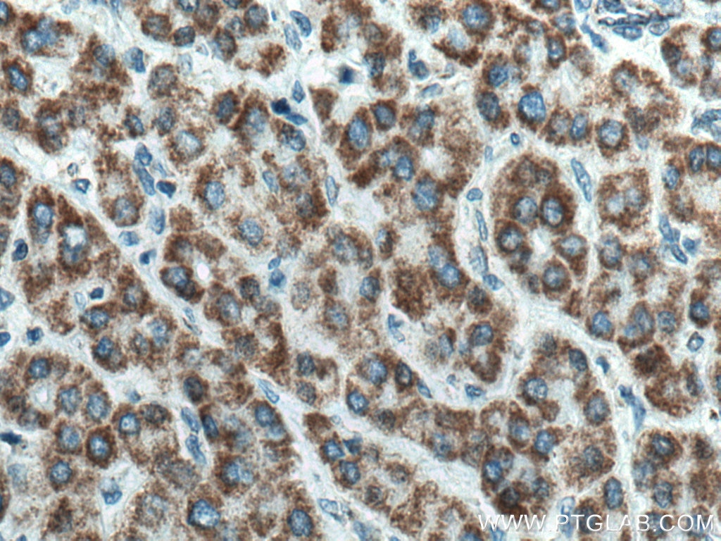 Immunohistochemistry (IHC) staining of human liver cancer tissue using DLD Polyclonal antibody (16431-1-AP)