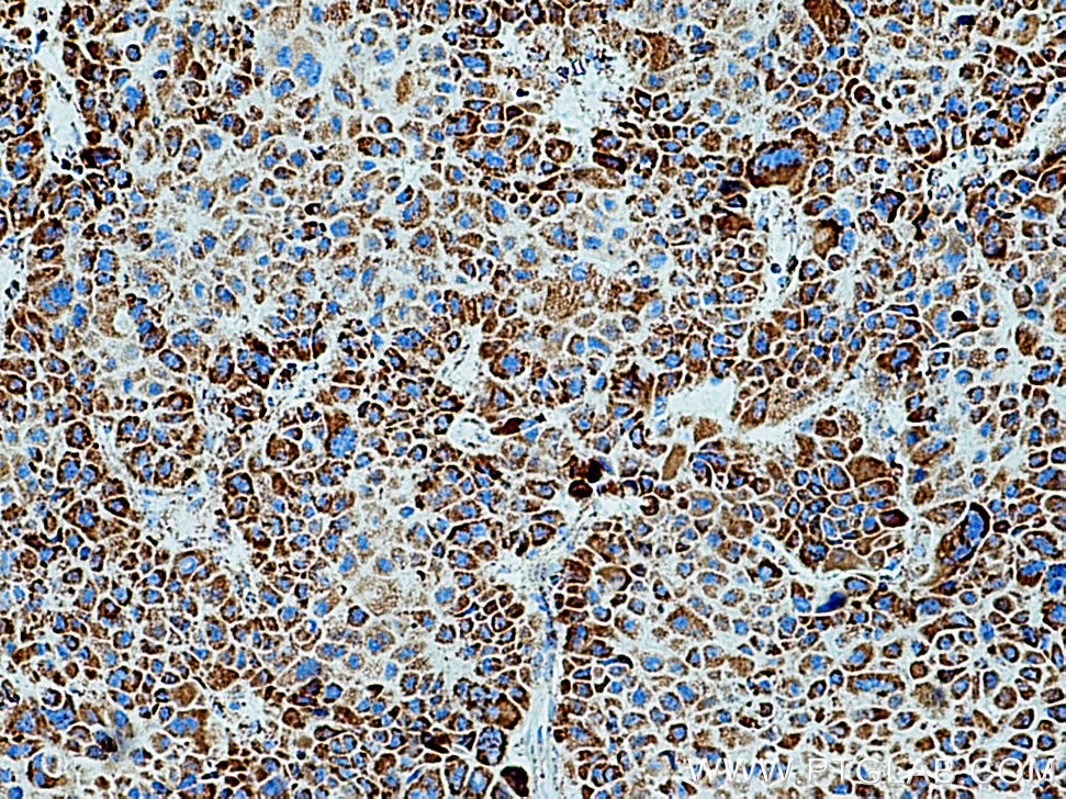 Immunohistochemistry (IHC) staining of human liver cancer tissue using DLD Polyclonal antibody (16431-1-AP)