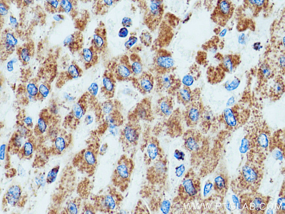 Immunohistochemistry (IHC) staining of human liver cancer tissue using DLD Polyclonal antibody (16431-1-AP)