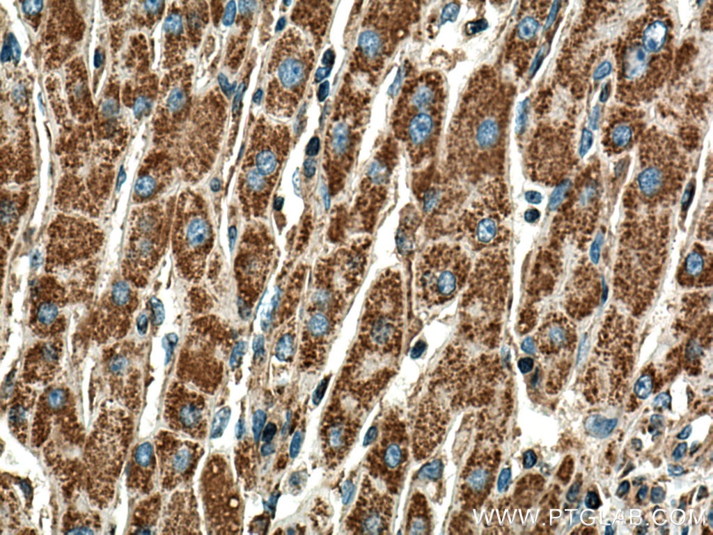 Immunohistochemistry (IHC) staining of human liver cancer tissue using DLD Monoclonal antibody (67702-1-Ig)