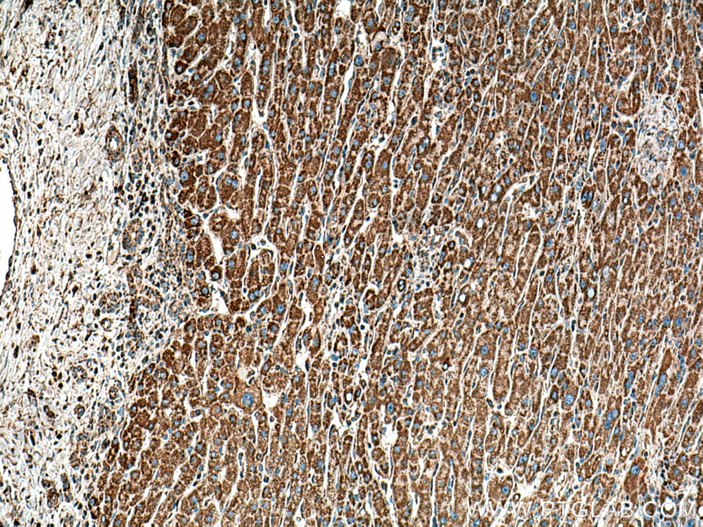 Immunohistochemistry (IHC) staining of human liver cancer tissue using DLD Monoclonal antibody (67702-1-Ig)