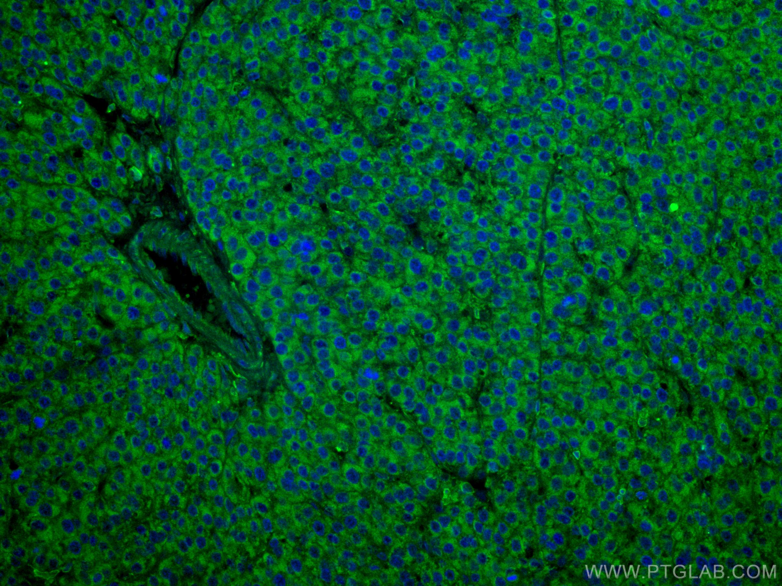 Immunofluorescence (IF) / fluorescent staining of human liver cancer tissue using CoraLite® Plus 488-conjugated DLD Monoclonal antib (CL488-67702)