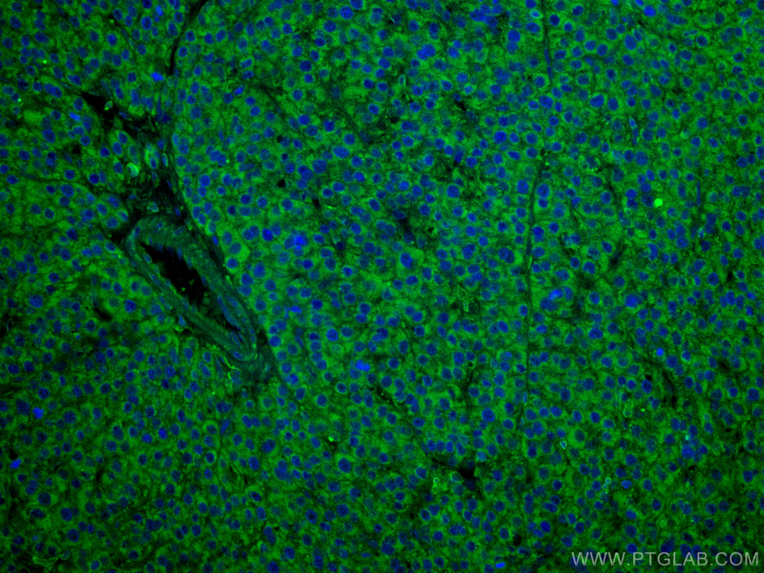 IF Staining of human liver cancer using CL488-67702