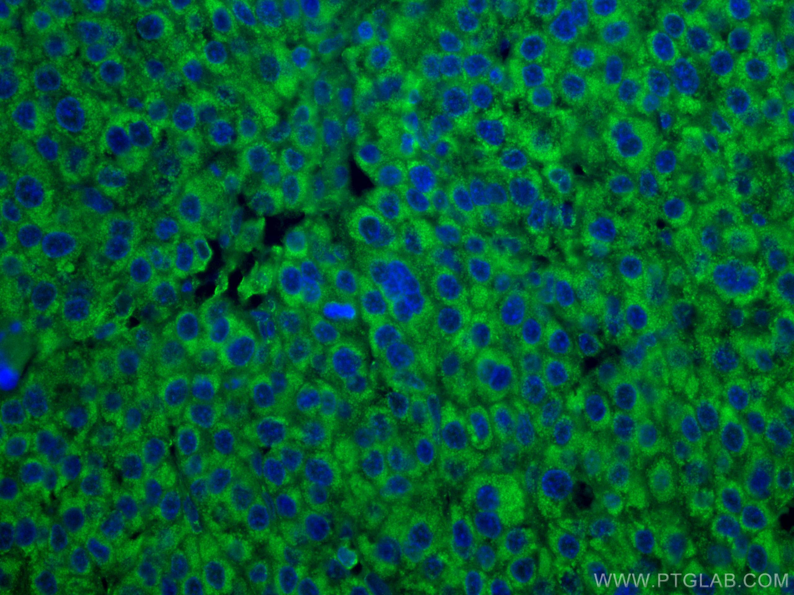 Immunofluorescence (IF) / fluorescent staining of human liver cancer tissue using CoraLite® Plus 488-conjugated DLD Monoclonal antib (CL488-67702)