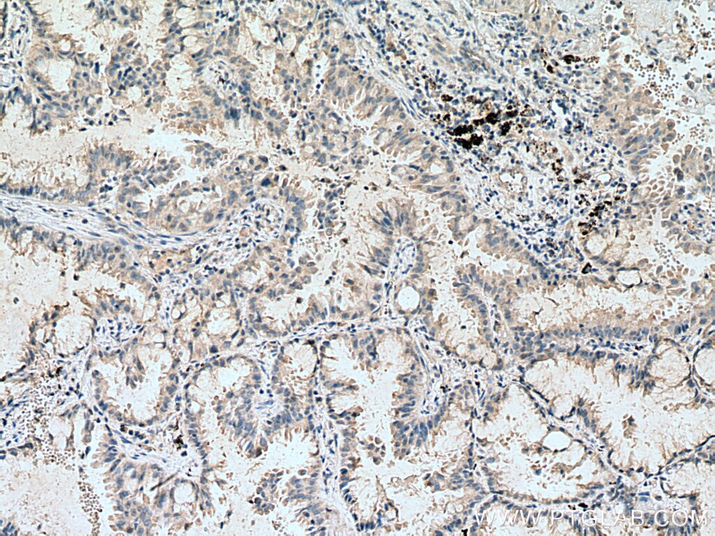 Immunohistochemistry (IHC) staining of human lung cancer tissue using DLEU1 Polyclonal antibody (11860-1-AP)