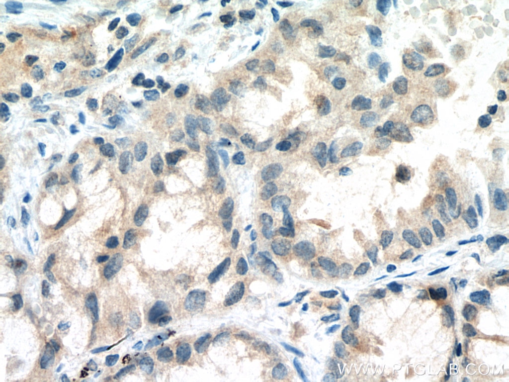 IHC staining of human lung cancer using 11860-1-AP