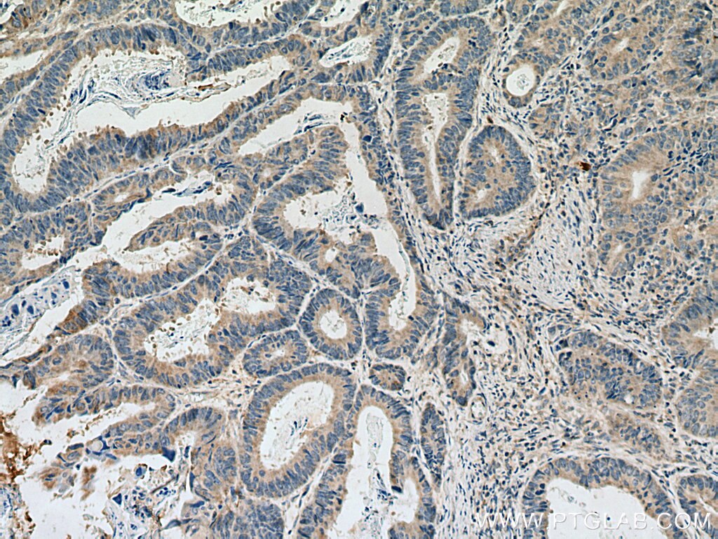 Immunohistochemistry (IHC) staining of human colon cancer tissue using DLEU1 Polyclonal antibody (11860-1-AP)