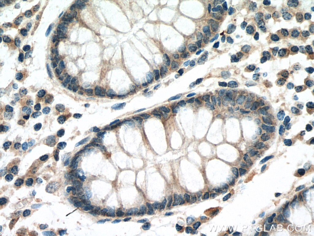 Immunohistochemistry (IHC) staining of human colon cancer tissue using DLEU1 Polyclonal antibody (11860-1-AP)