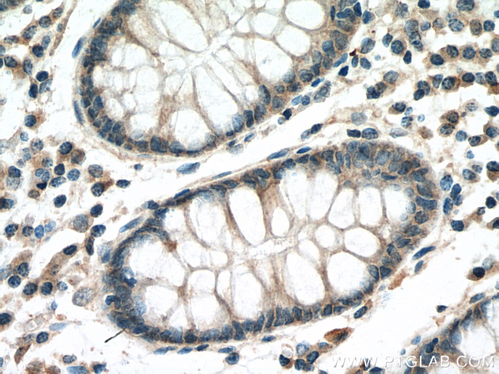 IHC staining of human colon cancer using 11860-1-AP