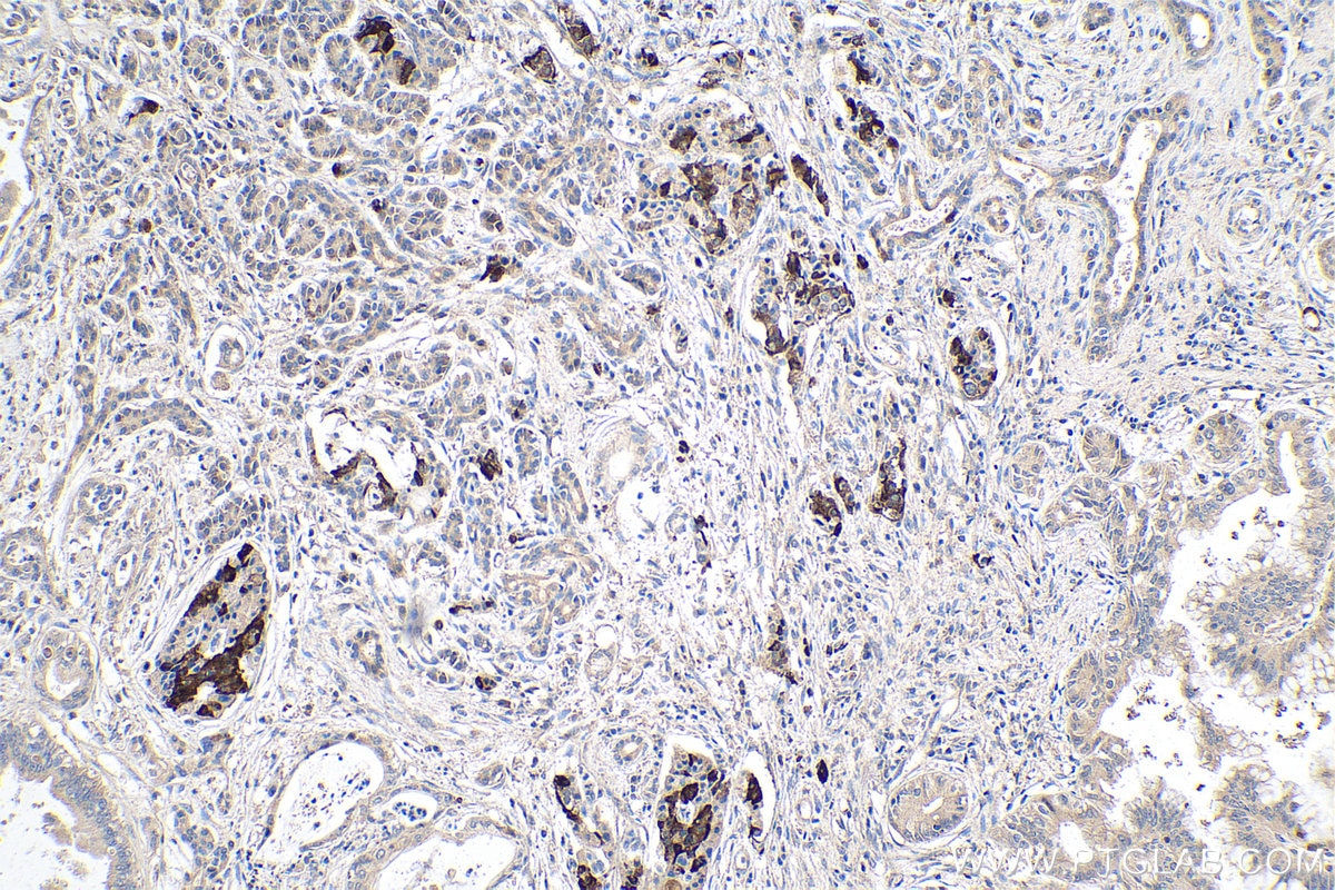 Immunohistochemistry (IHC) staining of human pancreas cancer tissue using DLK1 Polyclonal antibody (10636-1-AP)