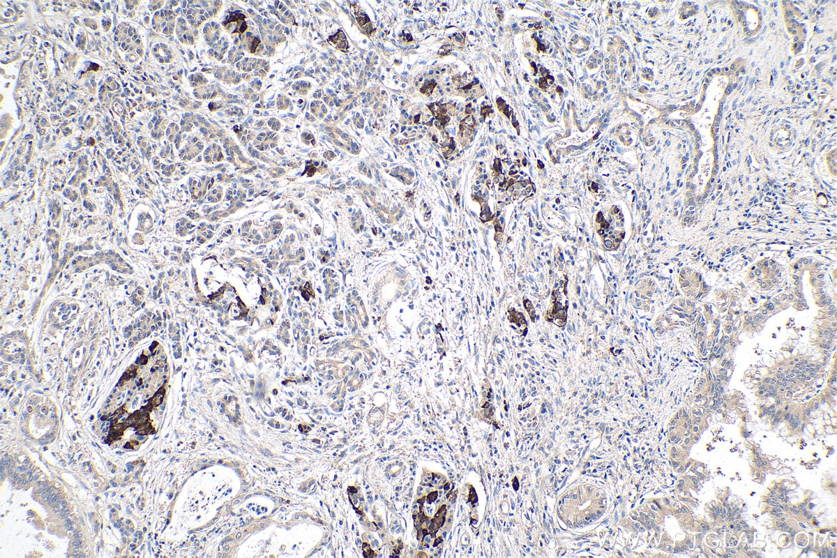 IHC staining of human pancreas cancer using 10636-1-AP