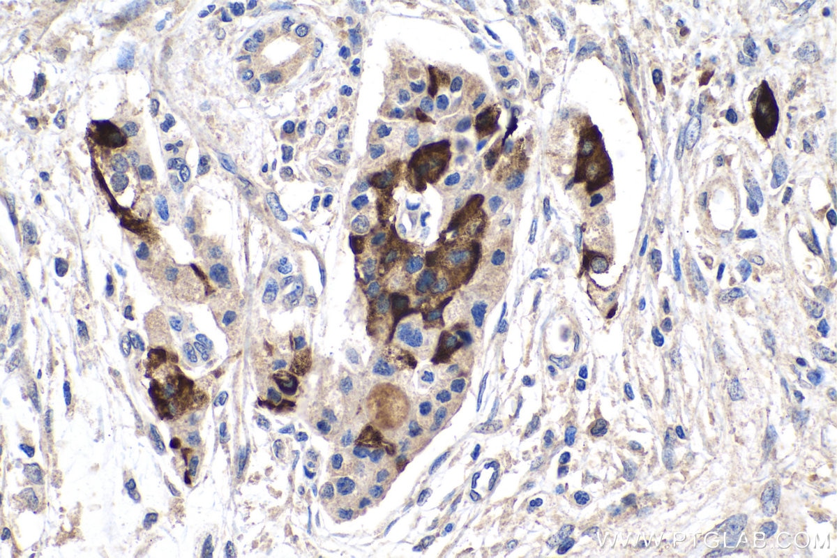 Immunohistochemistry (IHC) staining of human pancreas cancer tissue using DLK1 Polyclonal antibody (10636-1-AP)