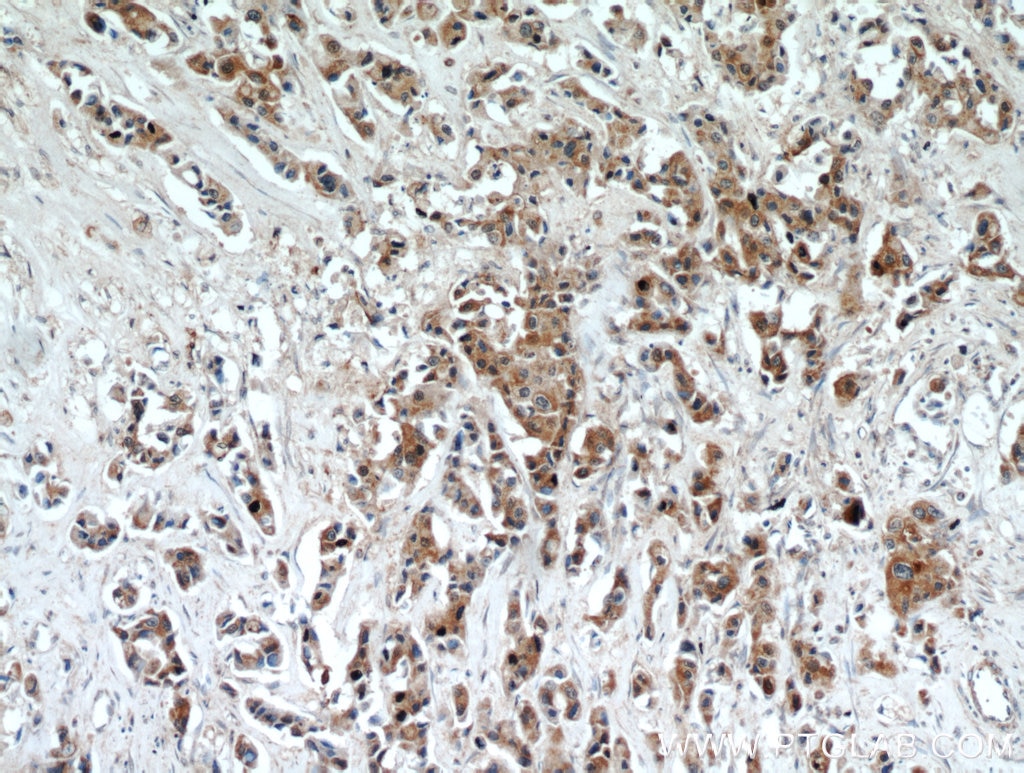 Immunohistochemistry (IHC) staining of human breast cancer tissue using DLK1 Polyclonal antibody (10636-1-AP)