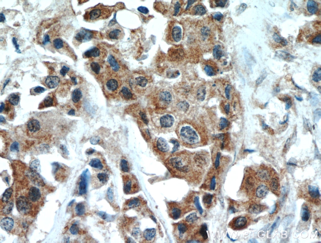 Immunohistochemistry (IHC) staining of human breast cancer tissue using DLK1 Polyclonal antibody (10636-1-AP)