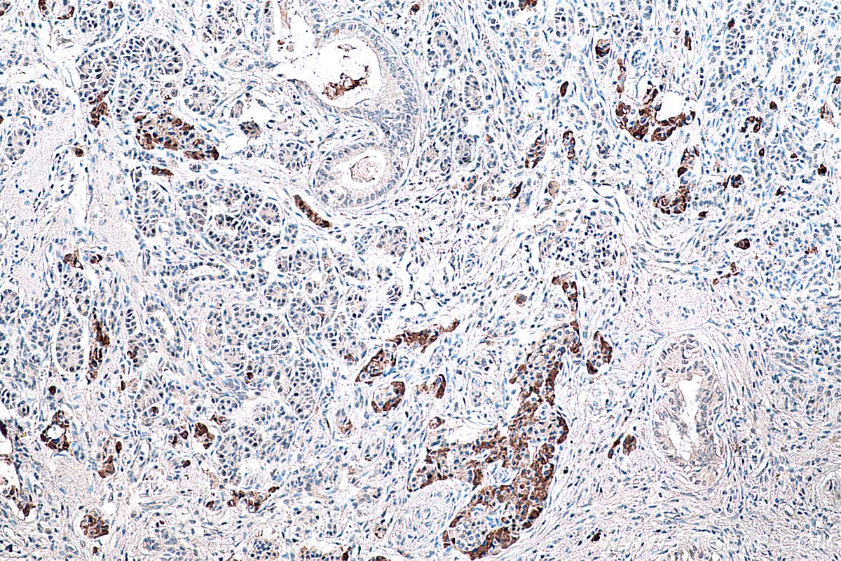 Immunohistochemistry (IHC) staining of human pancreas cancer tissue using DLK1 Monoclonal antibody (67923-1-Ig)