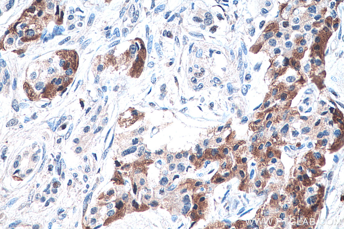 Immunohistochemistry (IHC) staining of human pancreas cancer tissue using DLK1 Monoclonal antibody (67923-1-Ig)