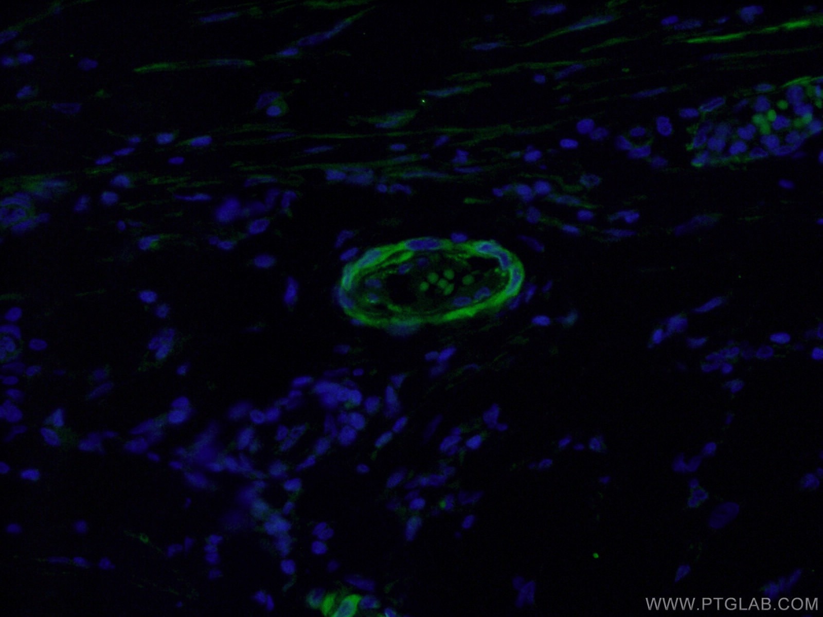 Immunofluorescence (IF) / fluorescent staining of human stomach cancer tissue using DLL4 Polyclonal antibody (21584-1-AP)