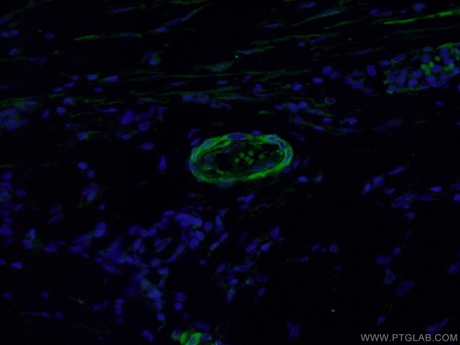 IF Staining of human stomach cancer using 21584-1-AP