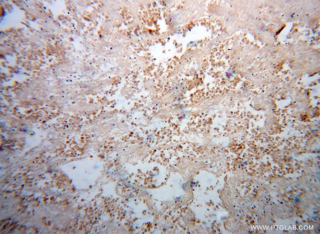 Immunohistochemistry (IHC) staining of human lung cancer tissue using DLX3 Polyclonal antibody (13261-3-AP)