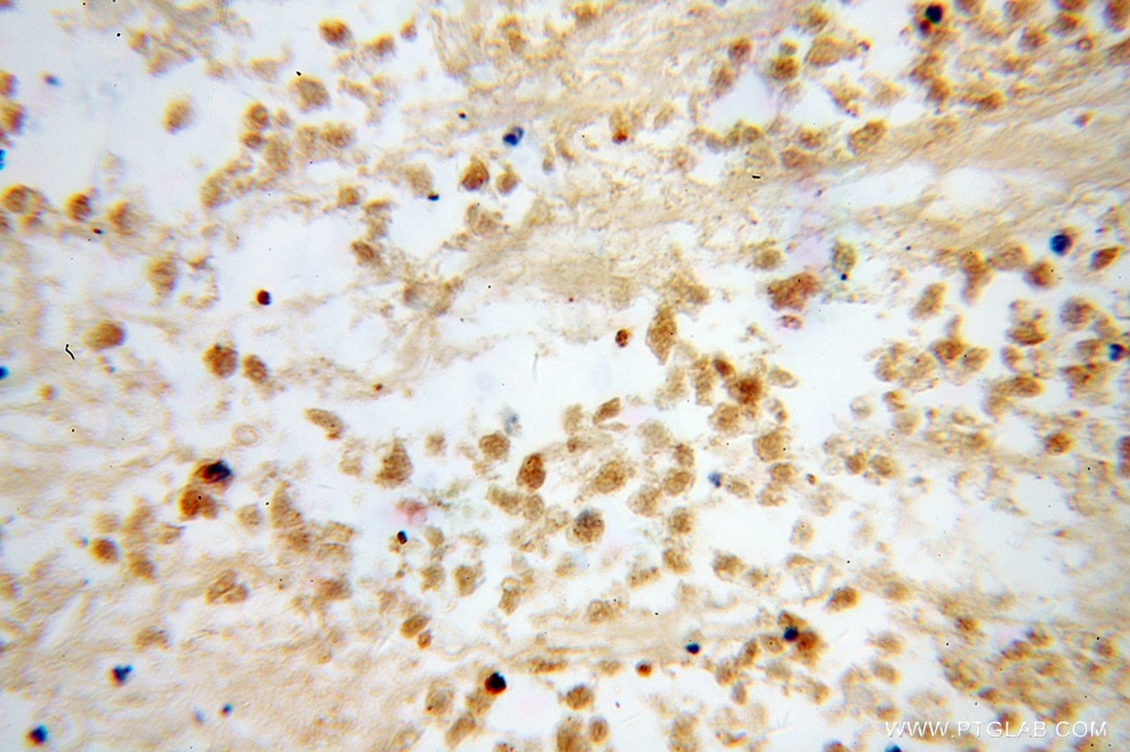 IHC staining of human lung cancer using 13261-3-AP