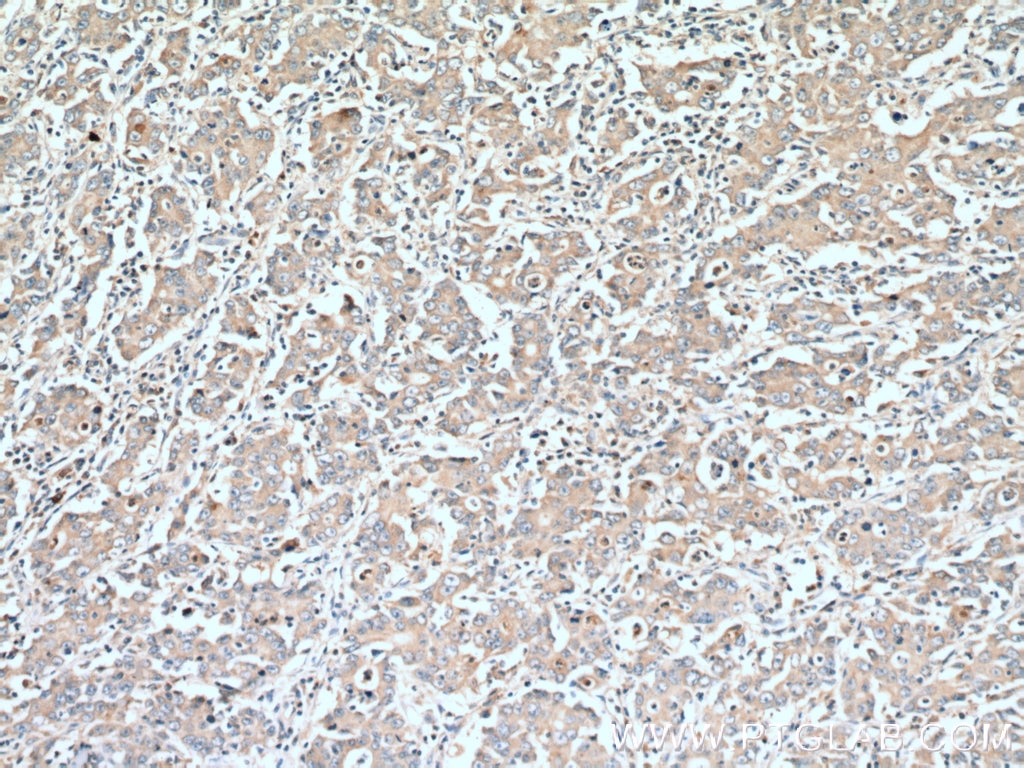 Immunohistochemistry (IHC) staining of human stomach cancer tissue using DMBT1 Polyclonal antibody (27069-1-AP)