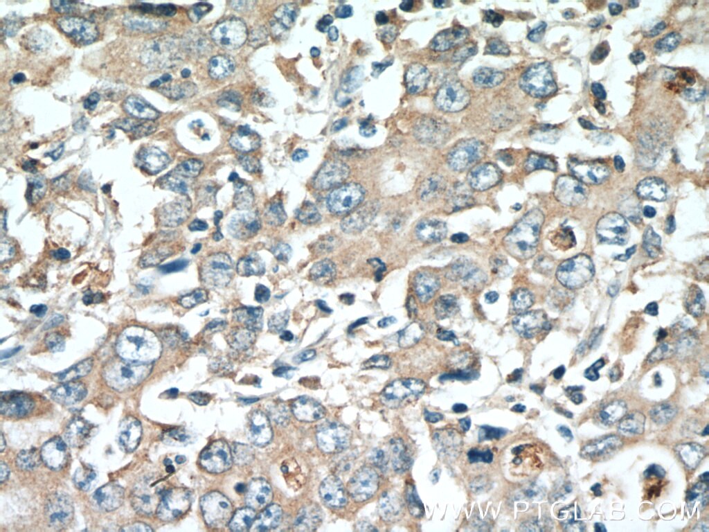 Immunohistochemistry (IHC) staining of human stomach cancer tissue using DMBT1 Polyclonal antibody (27069-1-AP)