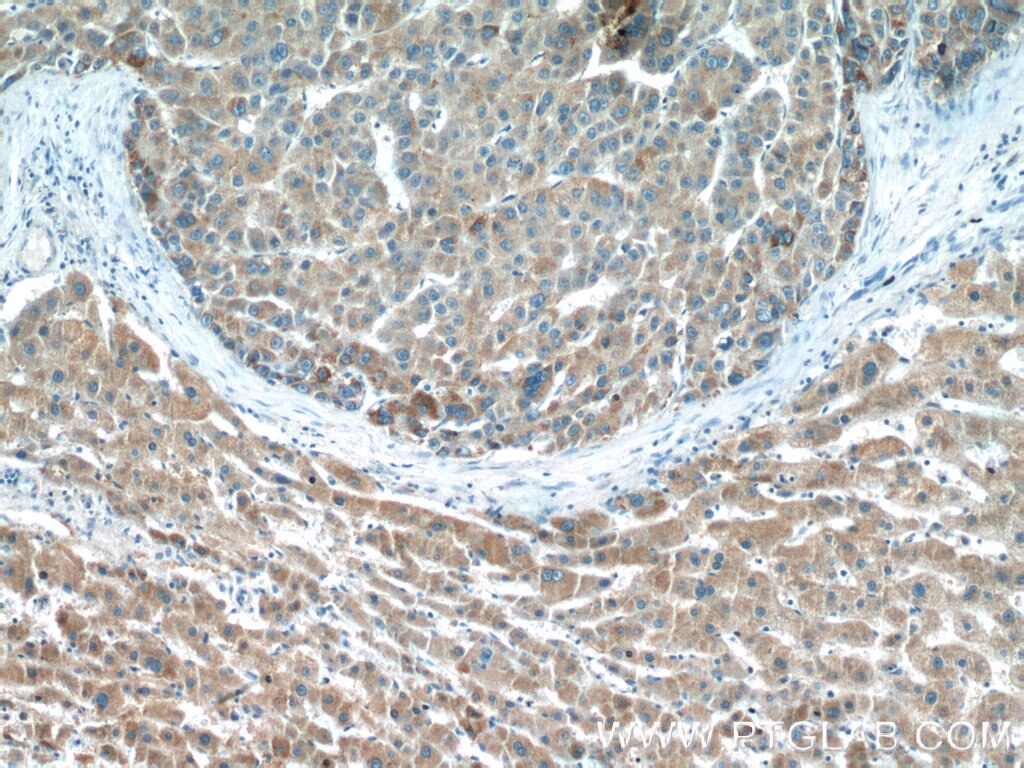 Immunohistochemistry (IHC) staining of human liver cancer tissue using DMGDH Polyclonal antibody (24813-1-AP)