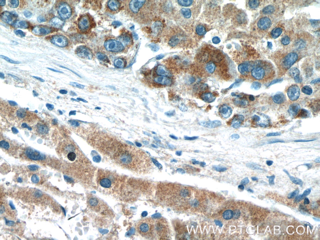 Immunohistochemistry (IHC) staining of human liver cancer tissue using DMGDH Polyclonal antibody (24813-1-AP)