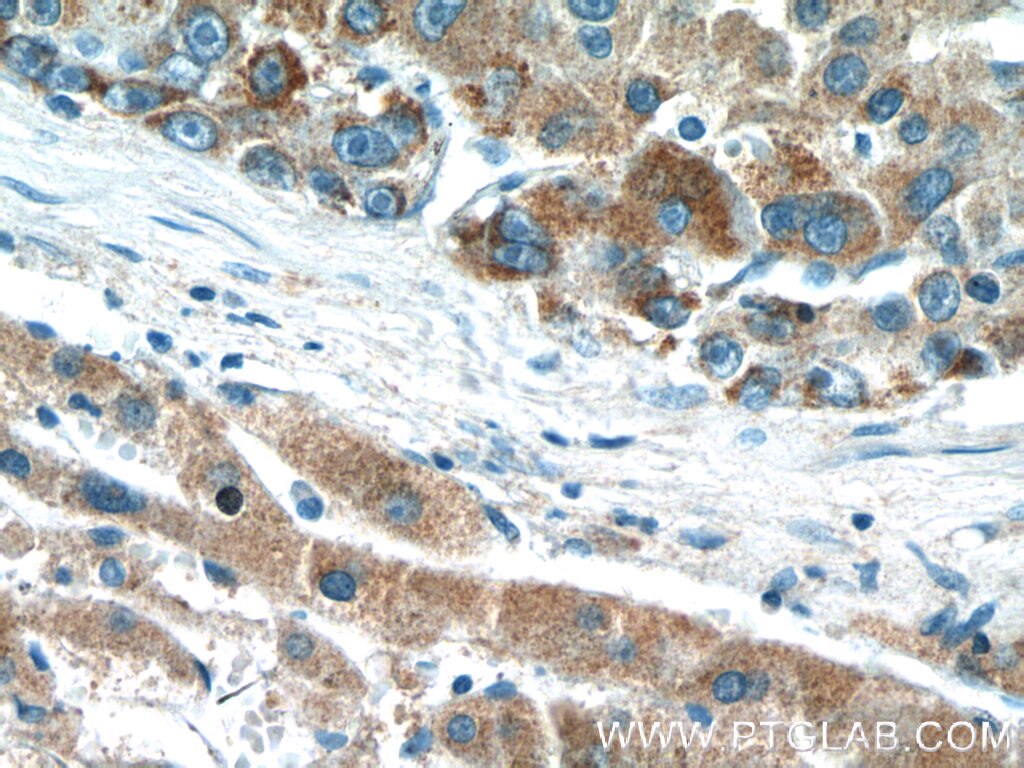 Immunohistochemistry (IHC) staining of human liver cancer tissue using DMGDH Polyclonal antibody (24813-1-AP)