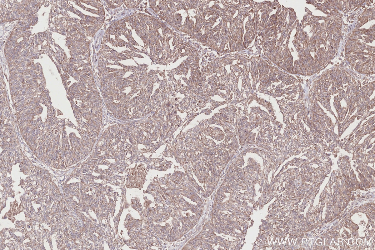 IHC staining of human ovary cancer using 24415-1-AP Immunohistochemistry (IHC) staining of human ovary cancer tissue using DMXL2 Polyclonal antibody (24415-1-AP)