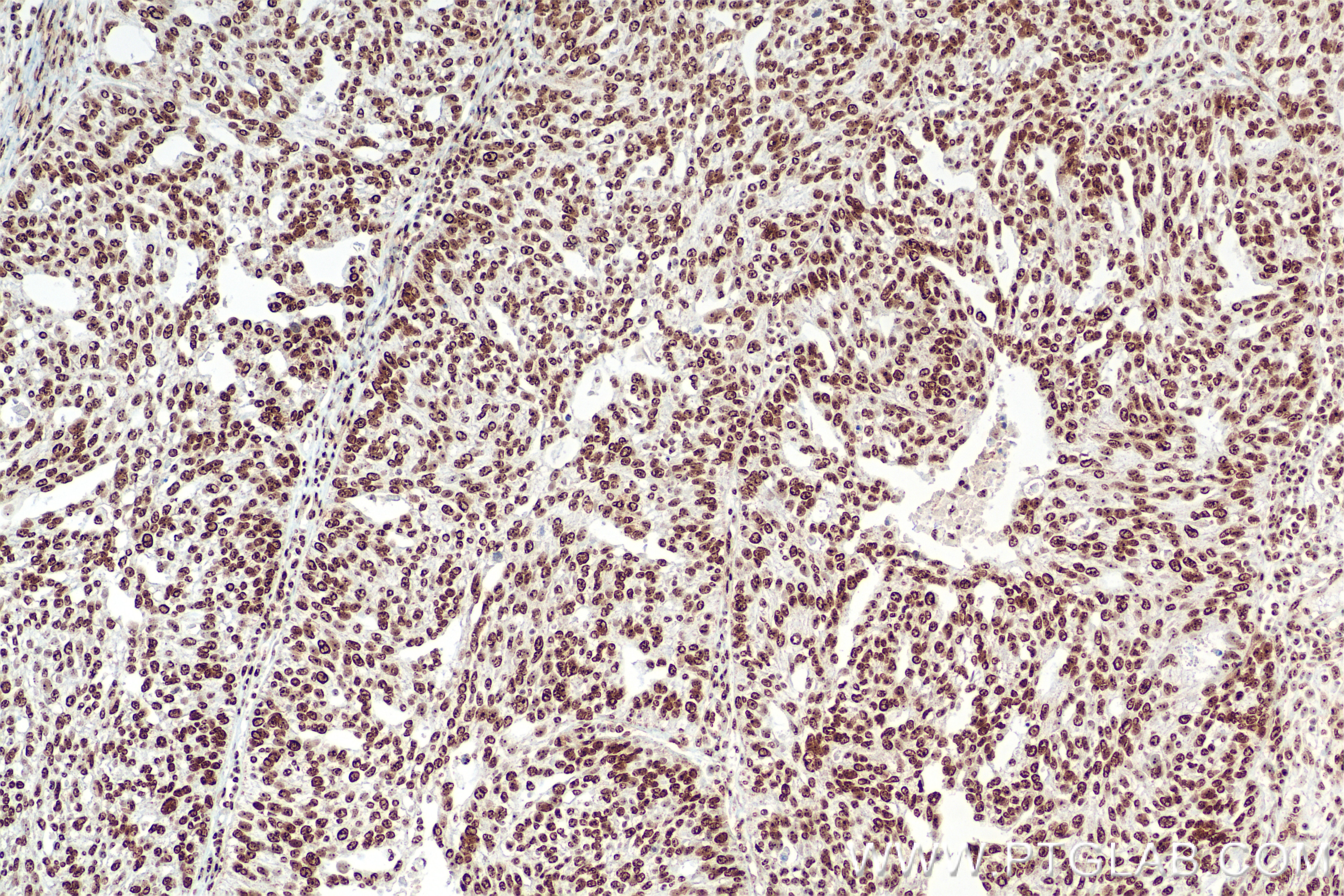 IHC staining of human ovary tumor using 85855-1-RR Immunohistochemistry (IHC) staining of human ovary tumor tissue using DNA-RNA Hybrid Recombinant monoclonal antibody (85855-1-RR)