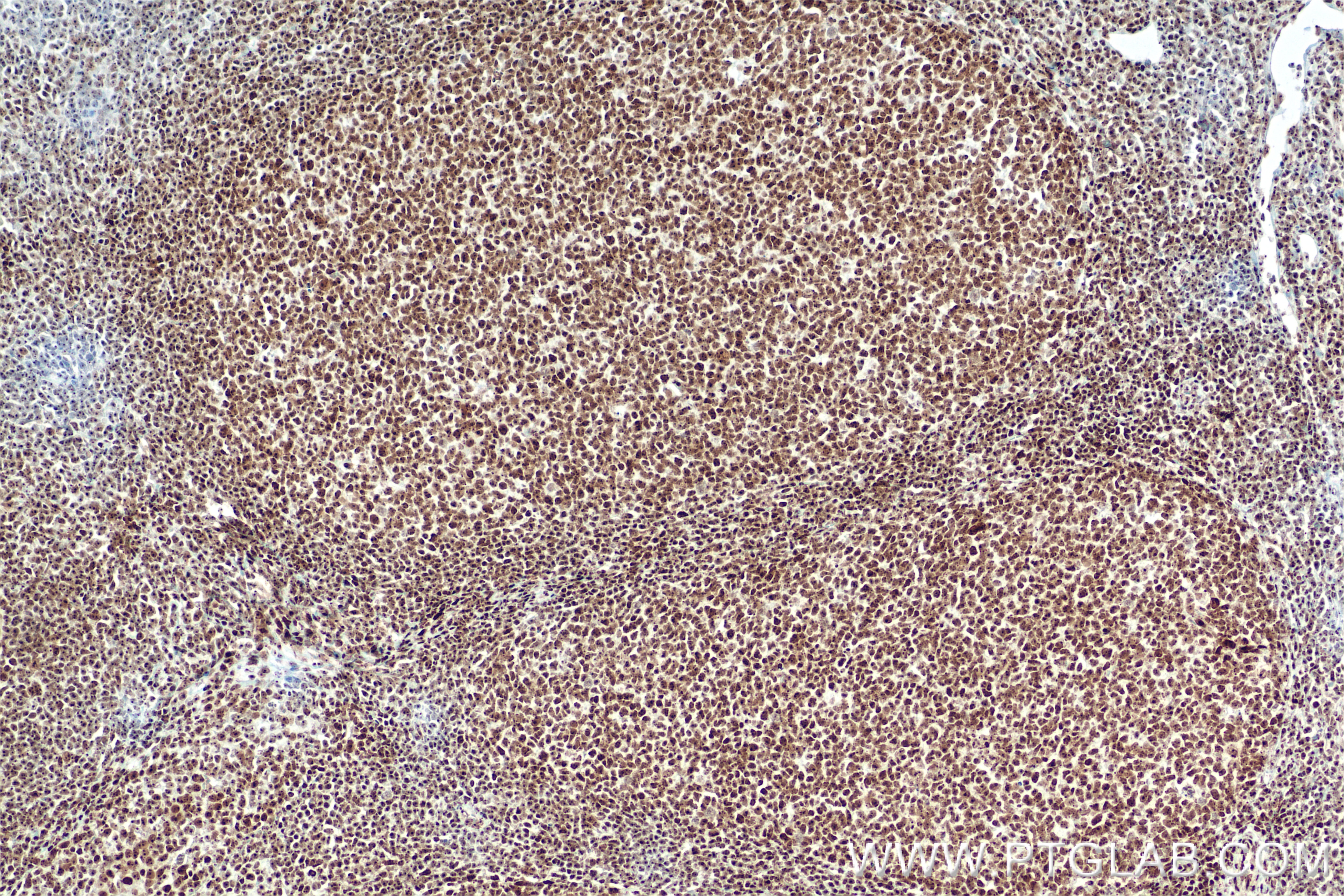 IHC staining of human tonsillitis using 85855-1-RR Immunohistochemistry (IHC) staining of human tonsillitis tissue using DNA-RNA Hybrid Recombinant monoclonal antibody (85855-1-RR)