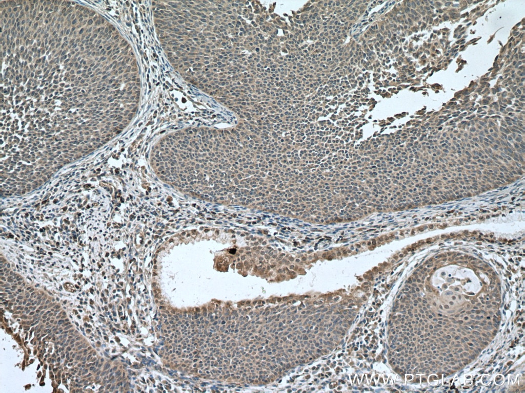 Immunohistochemistry (IHC) staining of human cervical cancer tissue using DNA2 Polyclonal antibody (18727-1-AP)