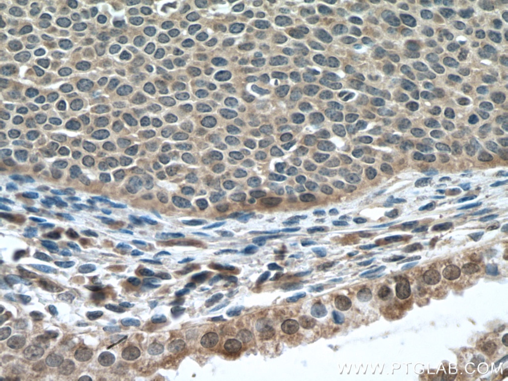 Immunohistochemistry (IHC) staining of human cervical cancer tissue using DNA2 Polyclonal antibody (18727-1-AP)
