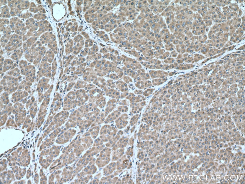 Immunohistochemistry (IHC) staining of human liver cancer tissue using DNA2 Polyclonal antibody (21599-1-AP)