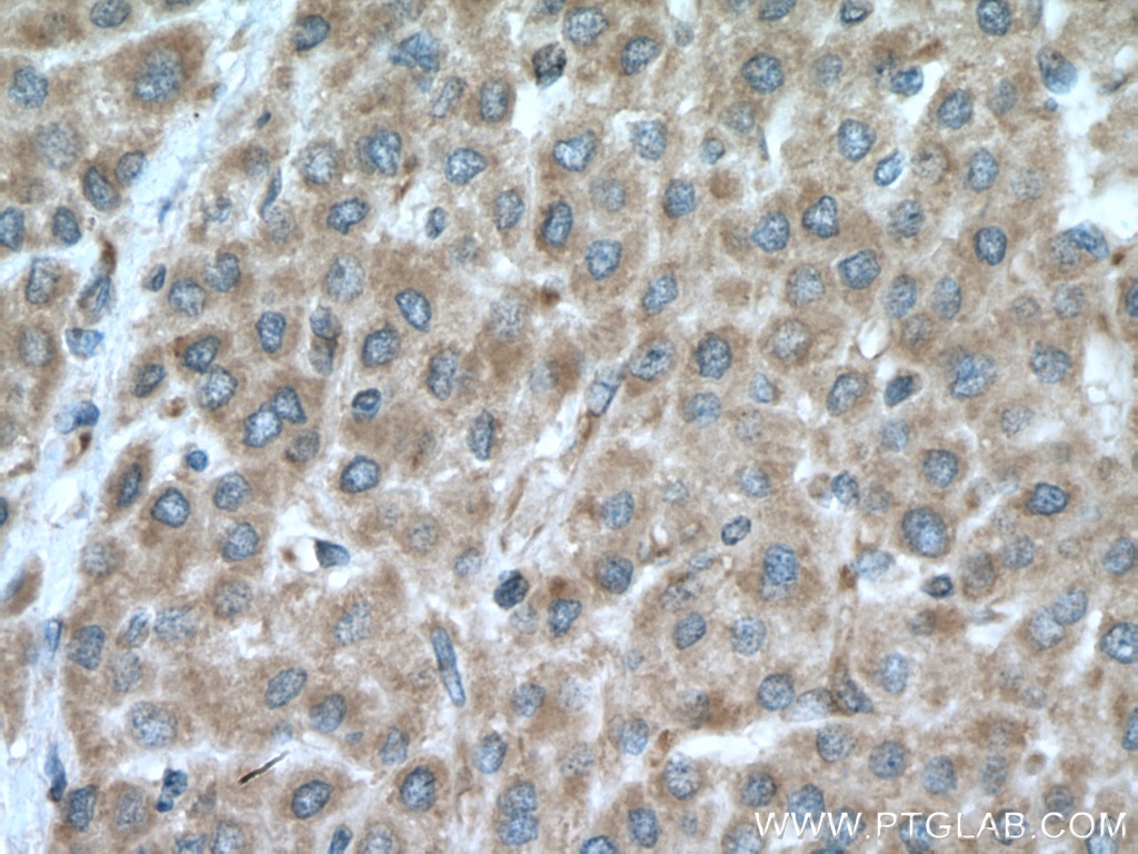 Immunohistochemistry (IHC) staining of human liver cancer tissue using DNA2 Polyclonal antibody (21599-1-AP)