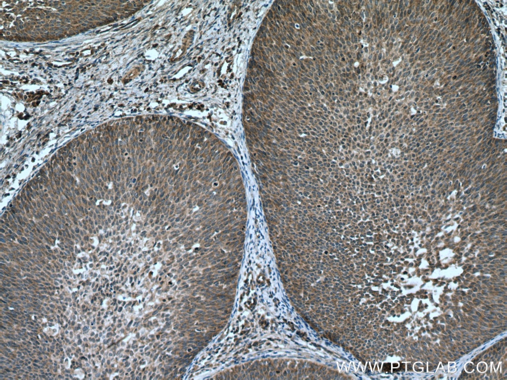 IHC staining of human cervical cancer using 21599-1-AP