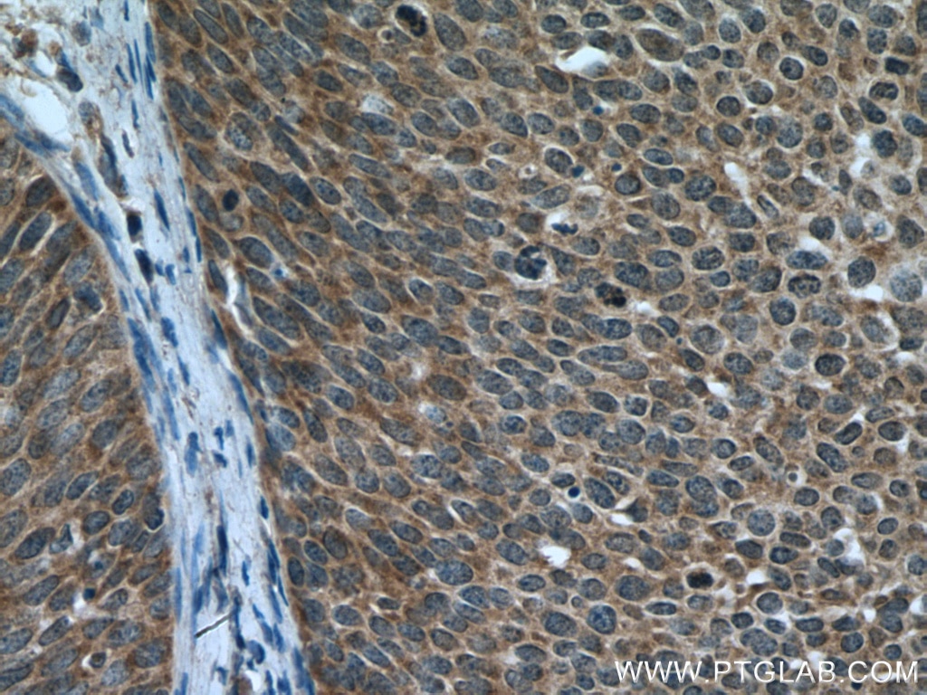 Immunohistochemistry (IHC) staining of human cervical cancer tissue using DNA2 Polyclonal antibody (21599-1-AP)