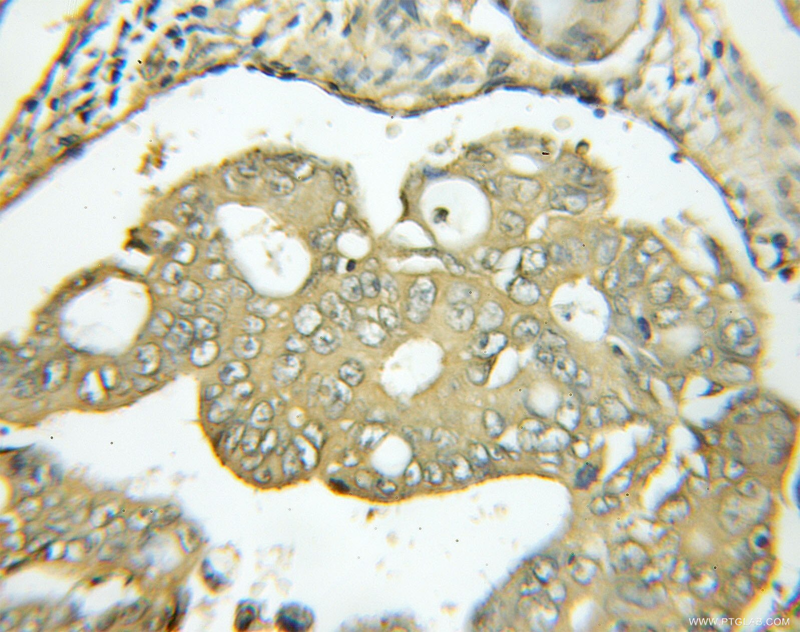 IHC staining of human colon cancer using 11713-1-AP